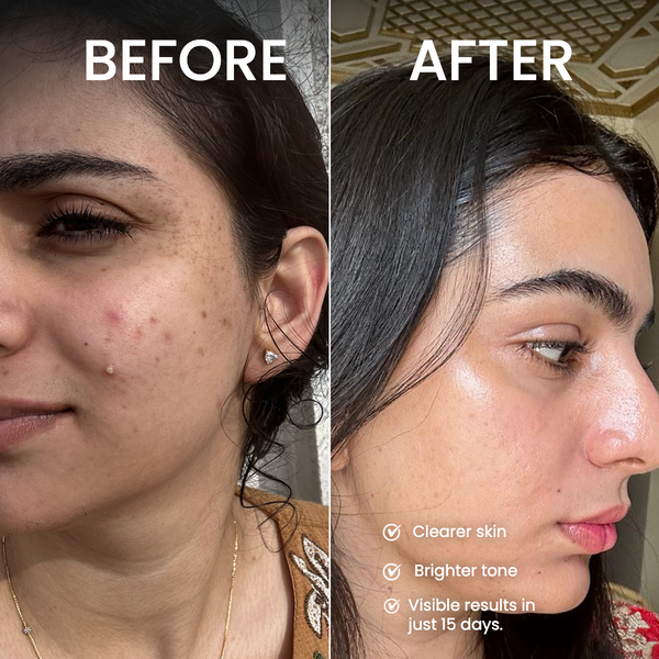 CLEAR COMPLEXION MINI KIT - Flawless skin in 15 days