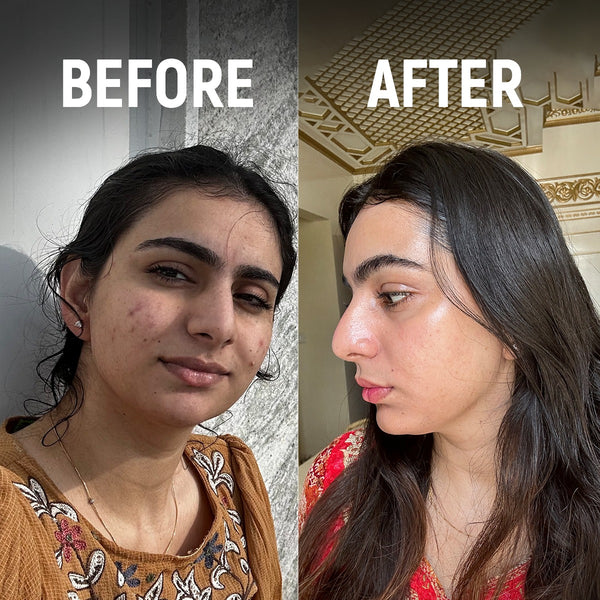 CLEAR COMPLEXION CHALLENGER KIT - Flawless skin in 15 days!